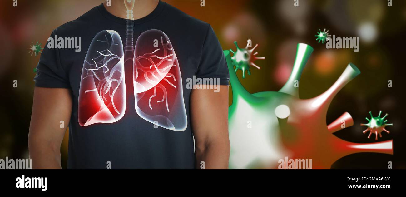 Mann mit kranker Lunge umgeben von Viren auf dunklem Hintergrund Stockfoto