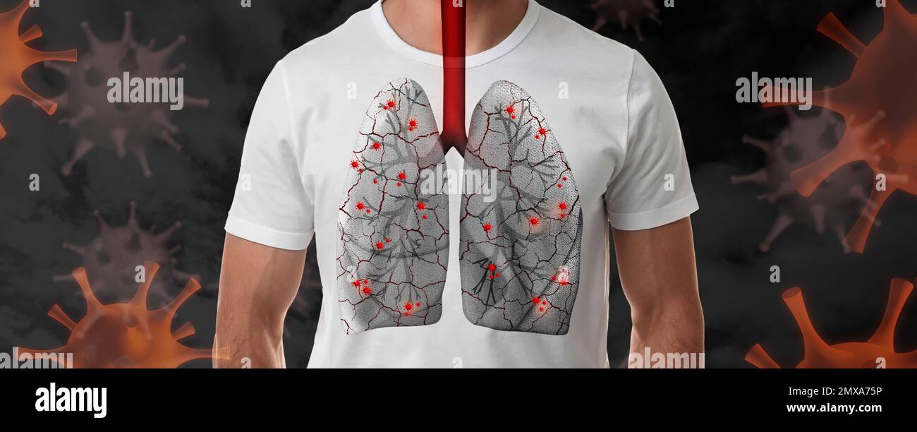 Mann mit kranker Lunge umgeben von Viren auf dunklem Hintergrund Stockfoto