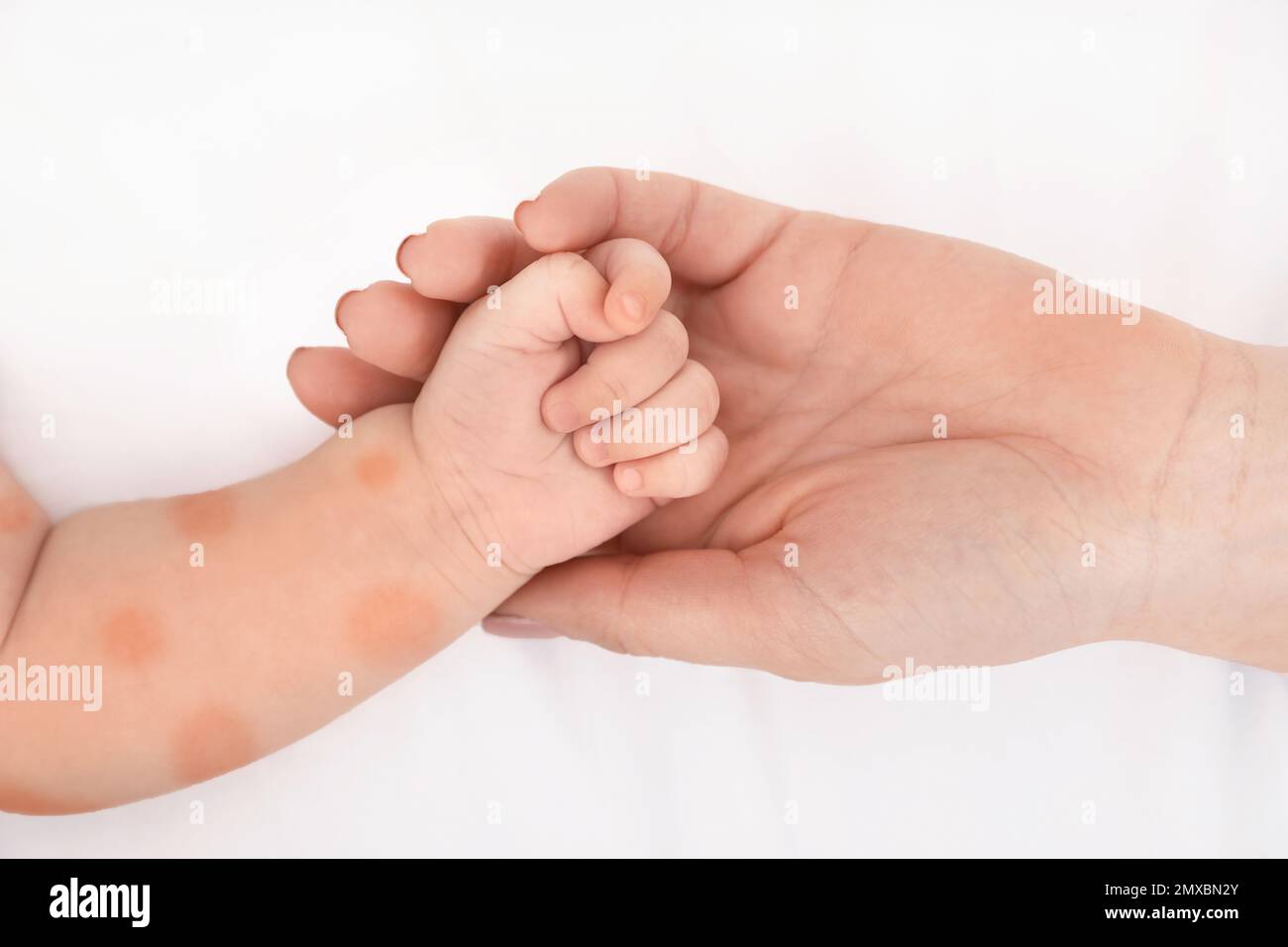 Mutter hielt die Hand ihres Kindes mit rotem Ausschlag, Nahaufnahme. Baby-Allergien Stockfoto
