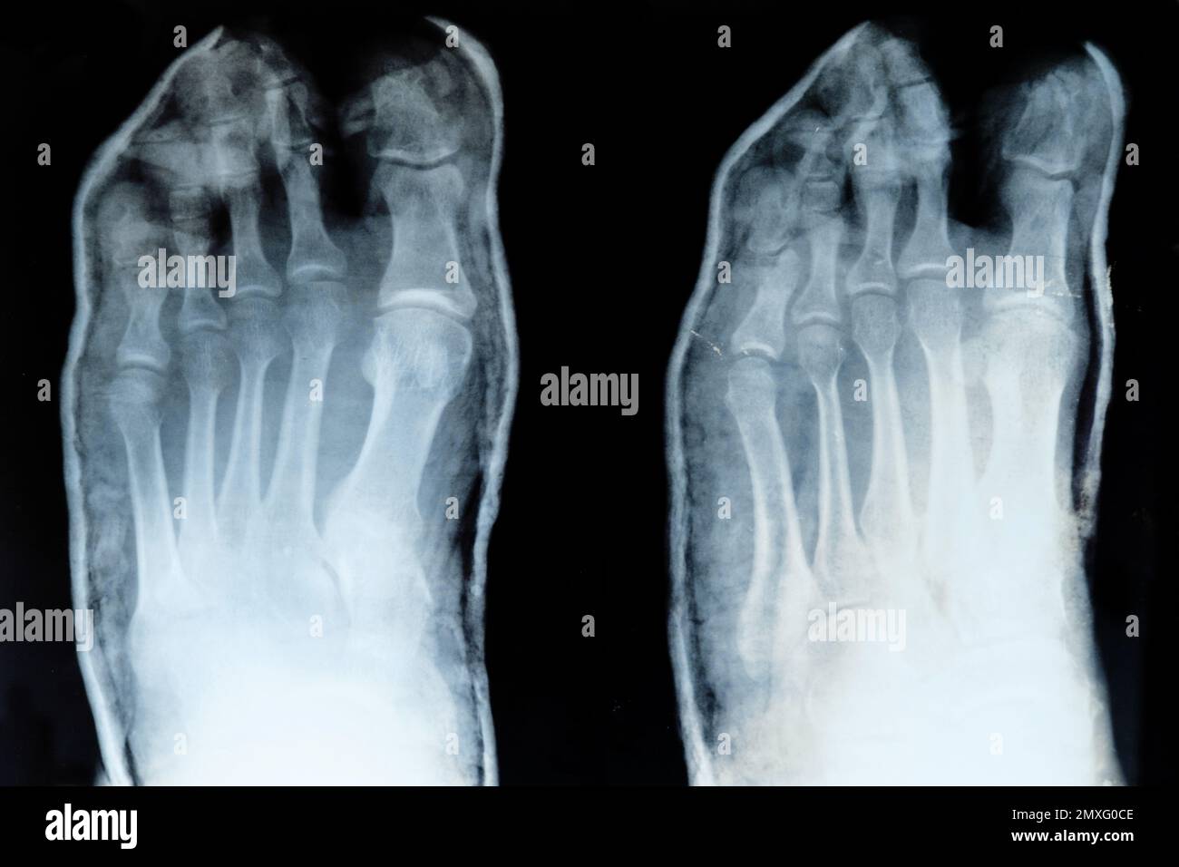 Röntgenaufnahme der Zehen mit verlagertem kleinen Finger Stockfoto