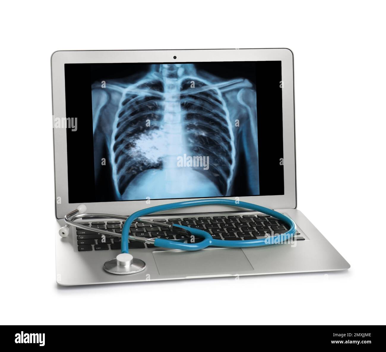 Laptop mit Röntgenaufnahme eines Lungenkrebspatienten auf weißem Hintergrund Stockfoto