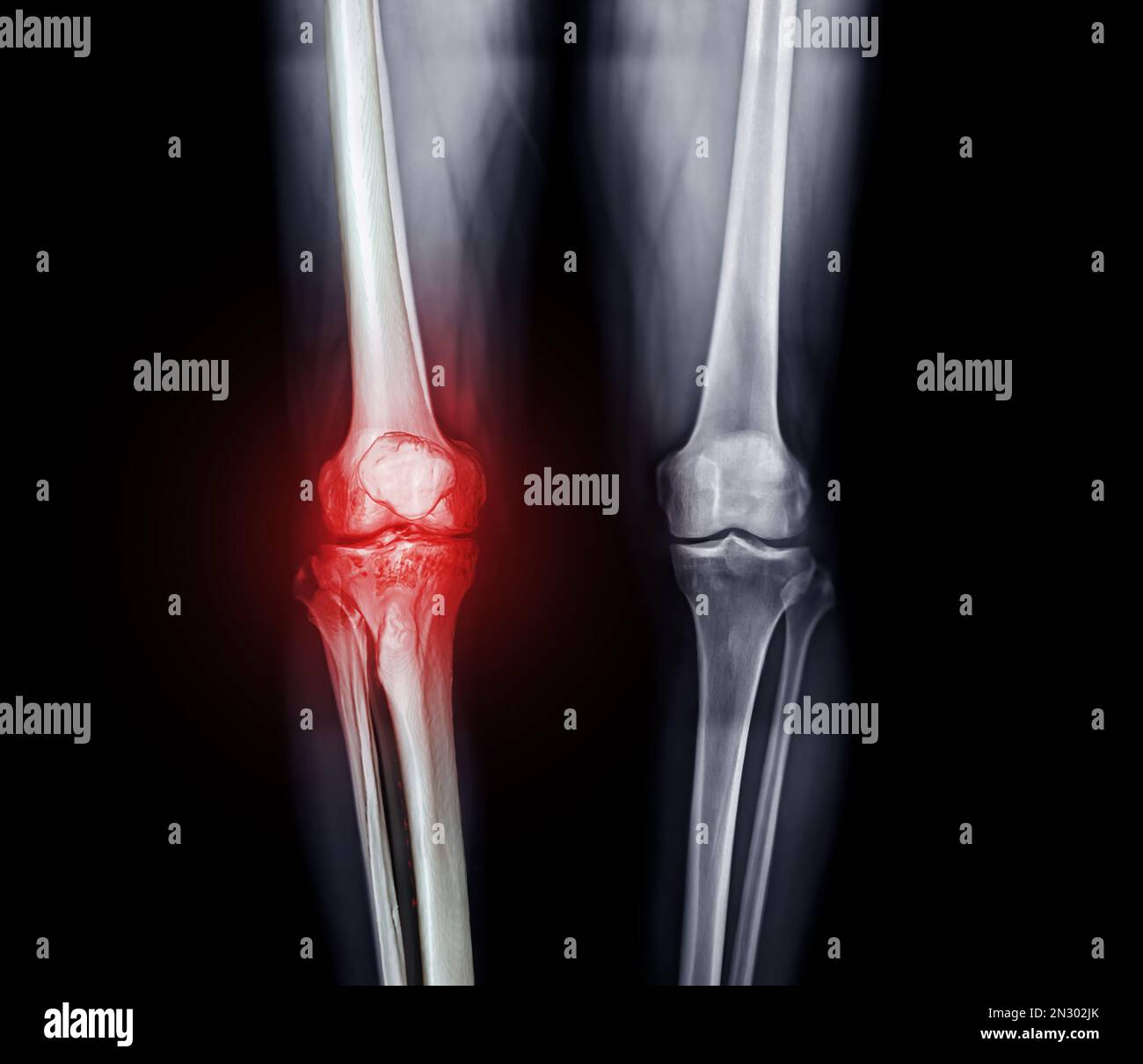 Röntgenbild beider Knie-AP-Ansicht bei diagnostischer Osteoarthritis ...