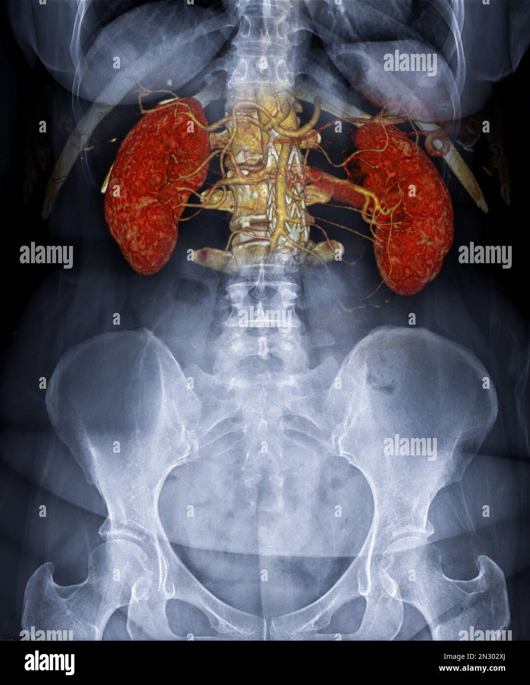 Abdominal aorta 3d ct scan -Fotos und -Bildmaterial in hoher Auflösung ...