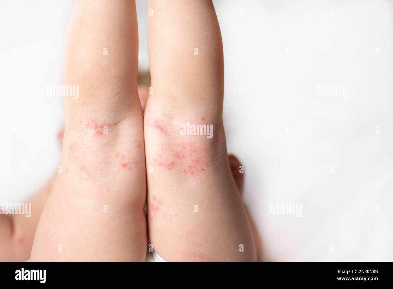 Hand-, Fuß- und Munderkrankungen Ausschlag an den Beinen eines Babys. Coxsackie-Virus Stockfoto