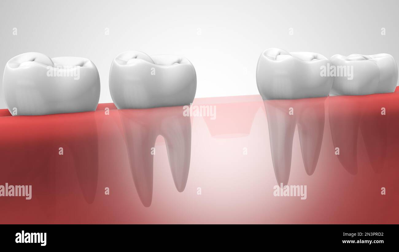Zahnimplantate in der menschlichen Denturra Stockfoto