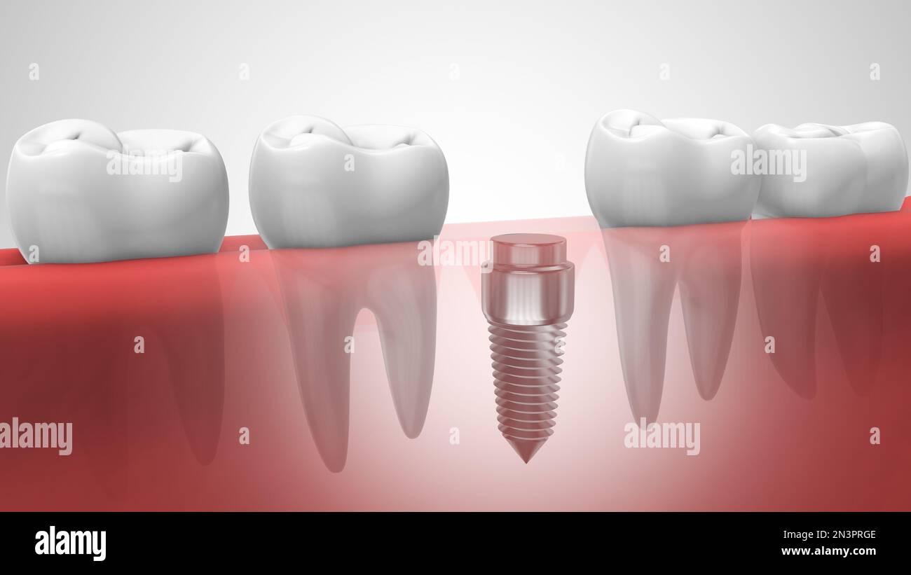 Zahnimplantate in der menschlichen Denturra Stockfoto