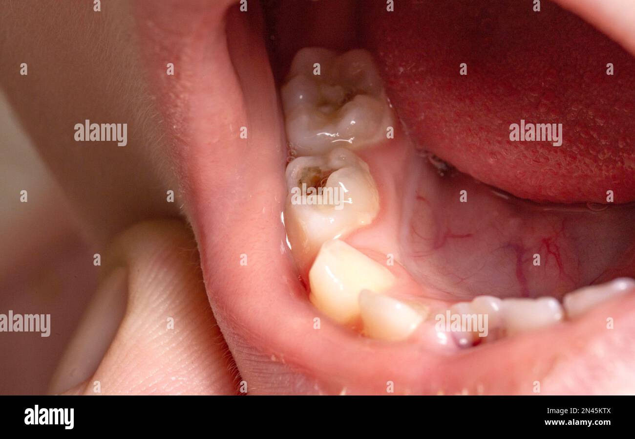Tiefes Karies bei Kindern auf Milchzähnen. Behandlung von Karies, Zahnschmerzen. Makro Stockfoto