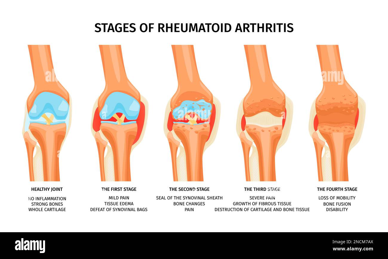 Realistische Infografiken zur Darstellung von vier Stadien der rheumatoiden Arthritis des Kniegelenkes Stock Vektor