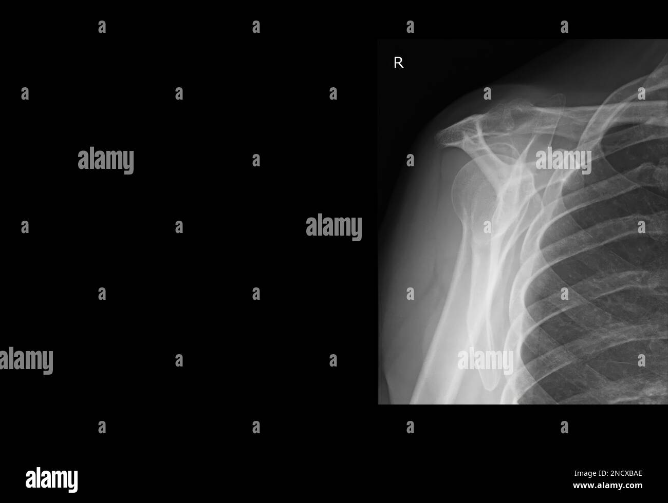 Röntgenbild einer menschlichen Schulter Stockfoto