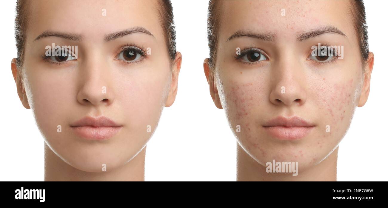 Collage mit Fotos von einem Mädchen im Teenageralter mit Akneproblem vor und nach Behandlung auf weißem Hintergrund. Bannerdesign Stockfoto