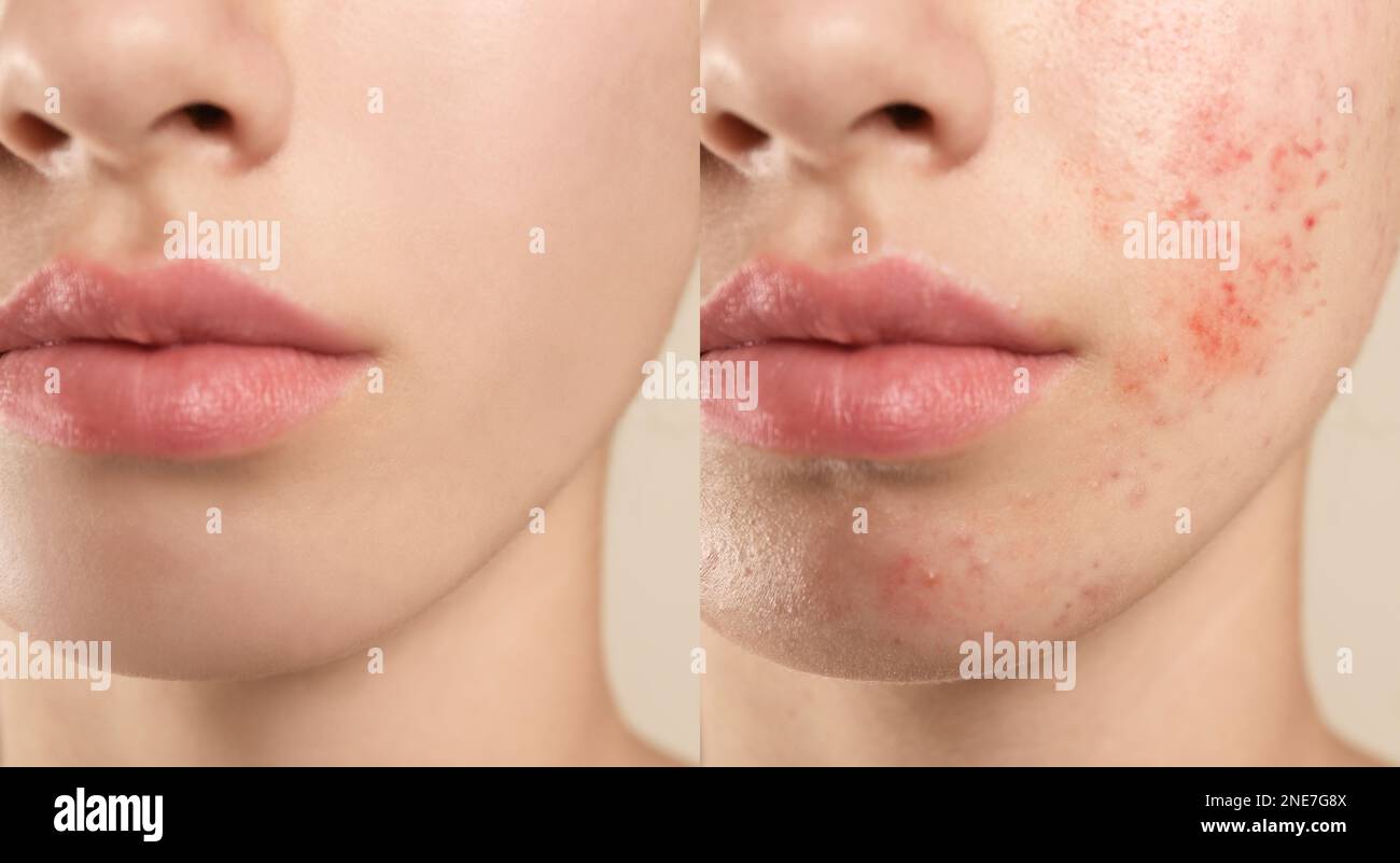 Collage mit Fotos von einem Mädchen im Teenageralter mit Akneproblem vor und nach der Behandlung, Nahaufnahme. Bannerdesign Stockfoto