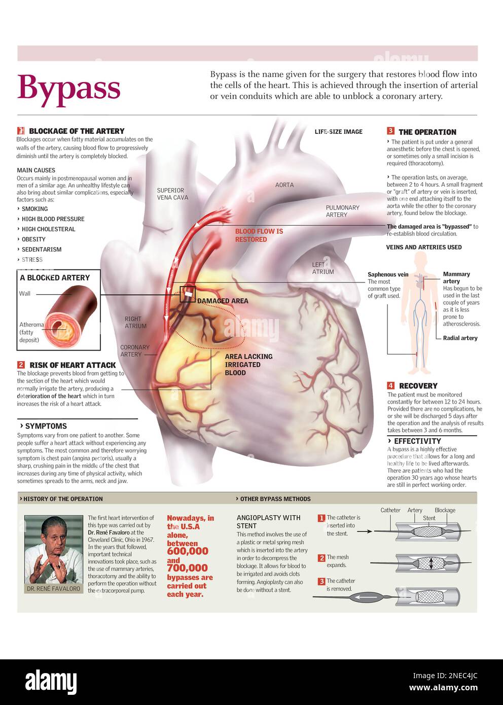 Infografiken zu den Ursachen einer blockierten Koronararterie und Pass-Kreislauf-Operation oder Wiederherstellung des Blutflusses zum Herzen. [Adobe Illustrator (.ai); 2480x3248]. Stockfoto