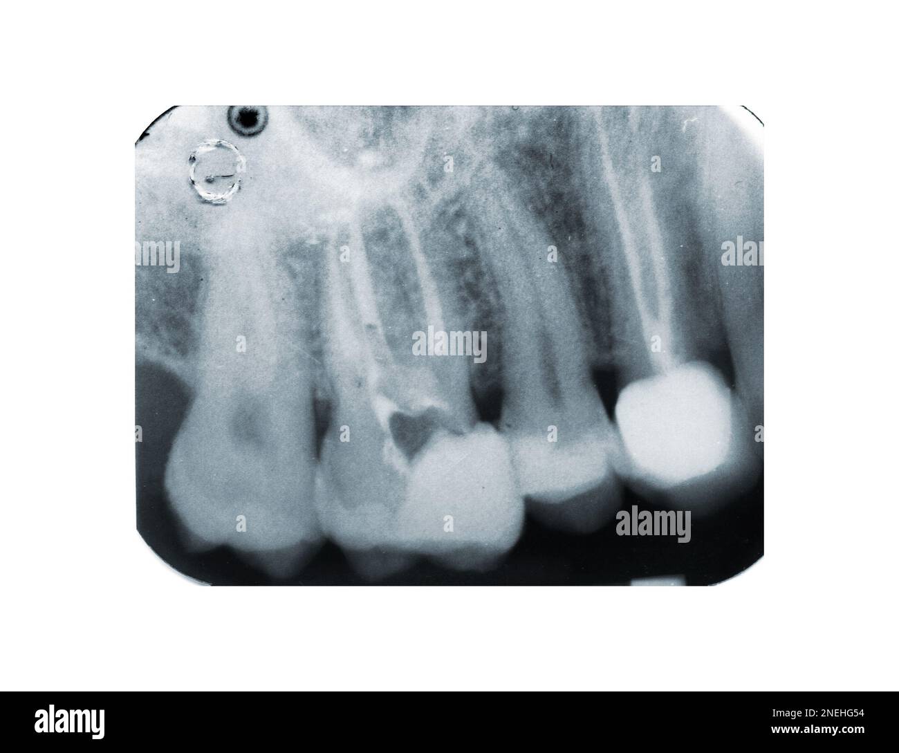 Reales Röntgenbild des devitalisierten Zahnes. Röntgenbild des Wurzelkanalbehandlungszahnes. Stockfoto