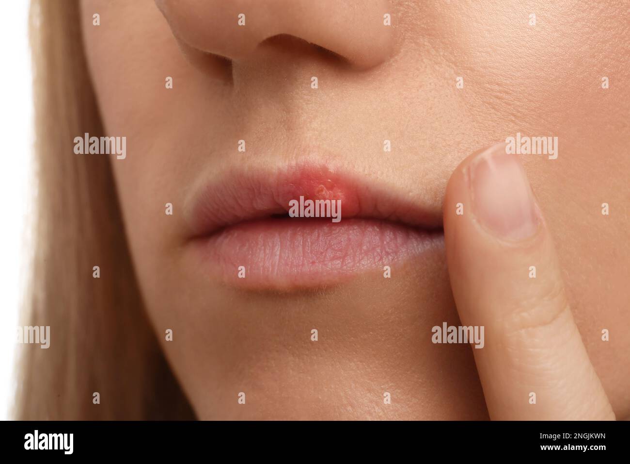 Frau mit Herpes, Nahaufnahme. Dermatologisches Problem Stockfoto