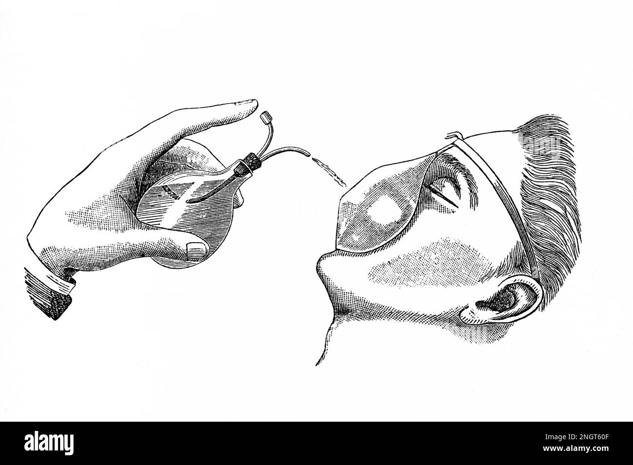 Esmarch-Apparat zur Verabreichung von Chloroform. Antike Ilustration aus einem Medizinbuch. 1889. Stockfoto