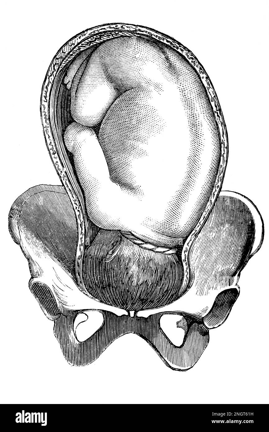 Nabelschnurprolaps. Antike Illustration aus einem Medizinbuch. 1889. Stockfoto