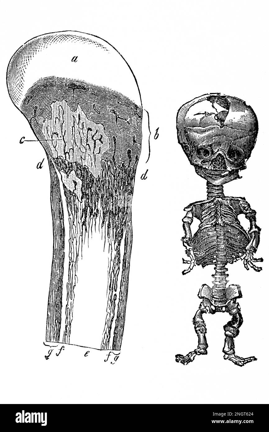Rachitis. Einfluss einer schlechten Ernährung im Kindesalter. Antike Illustration aus einem Medizinbuch. 1889. Stockfoto