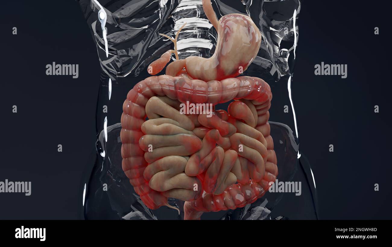 Mann mit Crohns-Krankheit, männliche Anatomie, entzündeter Dickdarm, Sigmoid Colon, Teile des menschlichen Verdauungssystems, 3D-Rendern Stockfoto