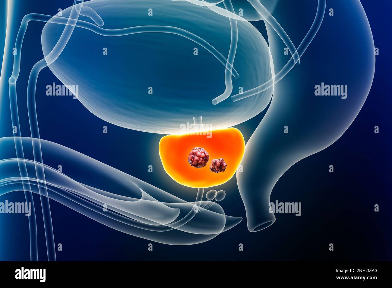 Prostatakarzinom mit Organen und Tumor oder Krebszellen 3D-Darstellung. Anatomie, Onkologie, Biomedizin, Krankheit, medizinisch, Biologie, Wissenschaft, Stockfoto
