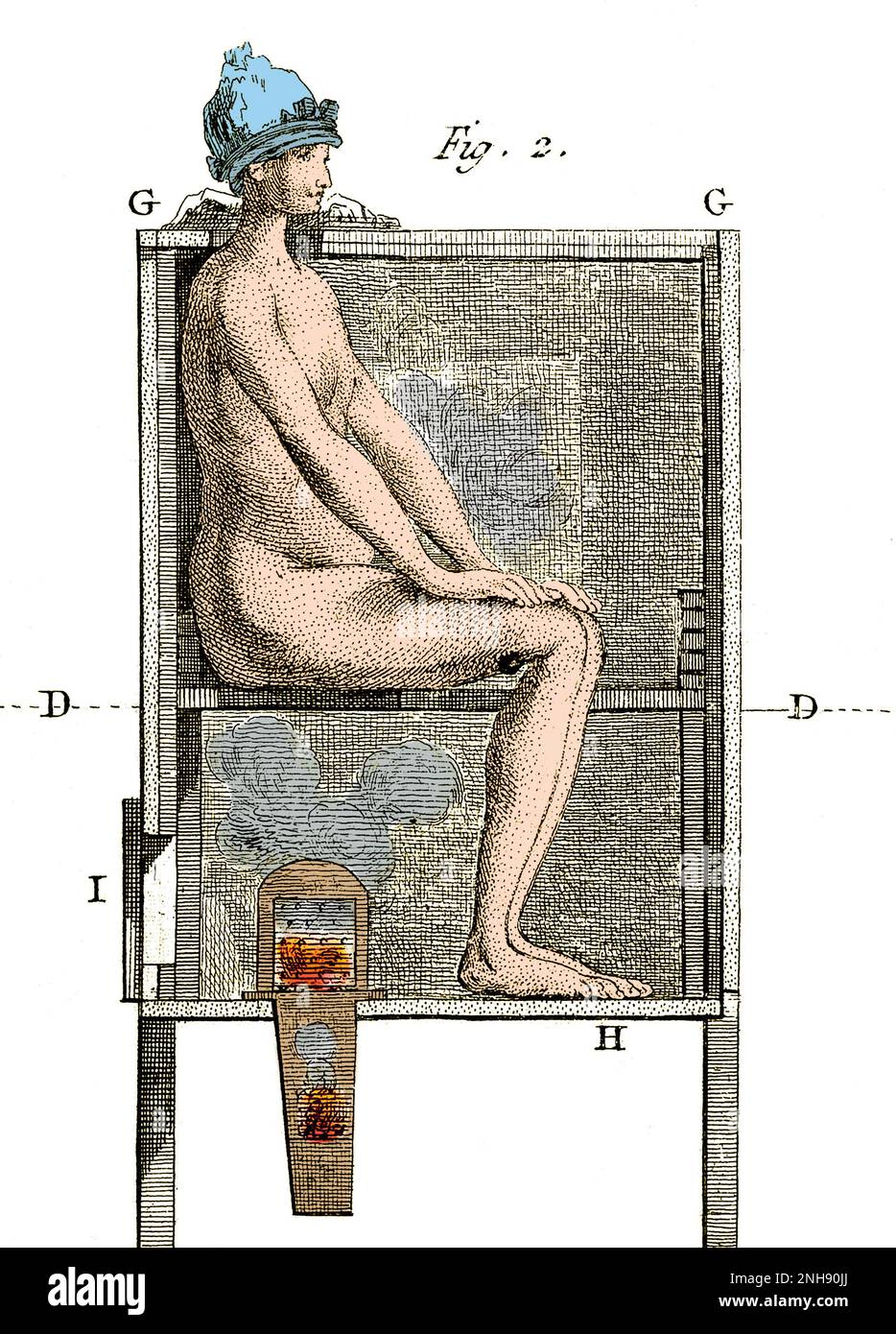 Abbildung zeigt eine Methode zur Behandlung von Geschlechtskrankheiten durch Begasung. Gravur von Pierre Lalouette, 1776. Gefärbt. Stockfoto