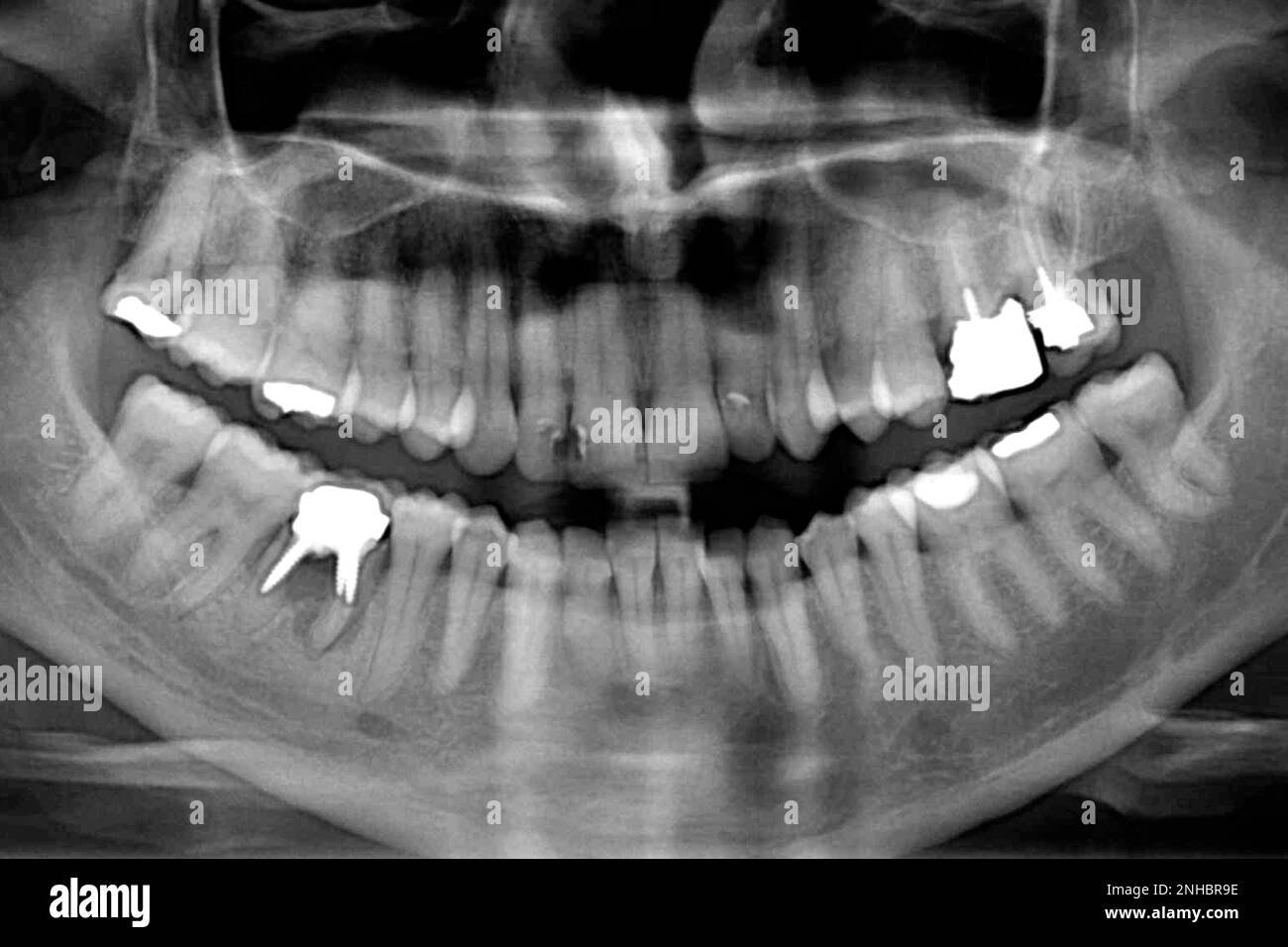 Panorama-Radiographie Stockfoto