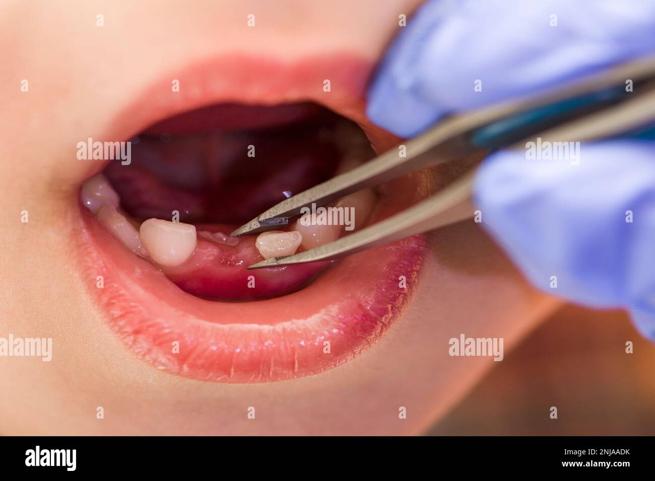 Kinderzähne. Der Arzt zieht einem Kind einen Zahn. Milchzähne bei einem Kind, Nahaufnahme Stockfoto