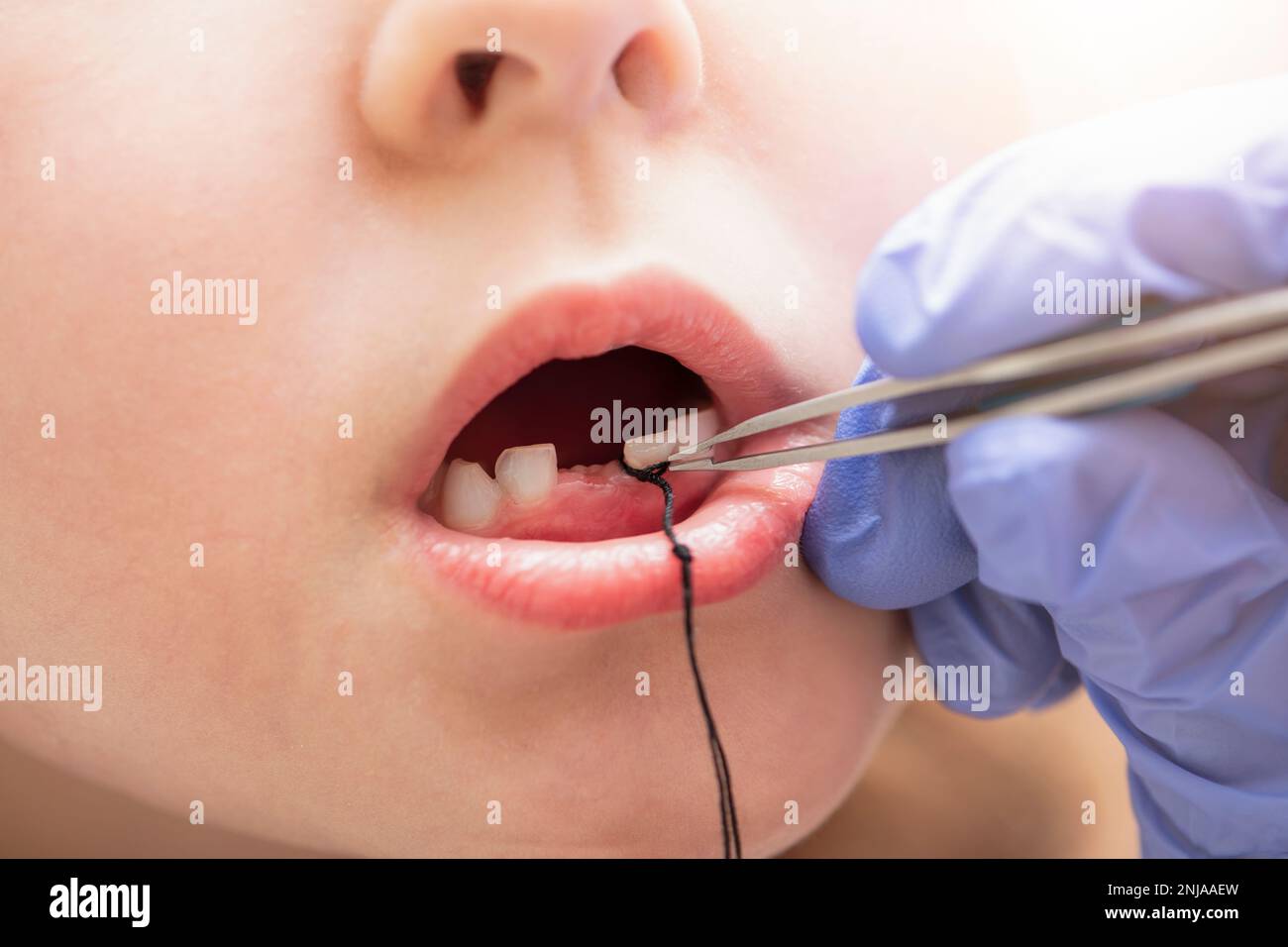 Extraktion eines Milchzahns bei einem Kind. Selbstextraktion eines Zahnes mit Zahnseide zu Hause. Binden Sie eine Zahnseide an den Zahn, um ihn herauszuziehen. Stockfoto