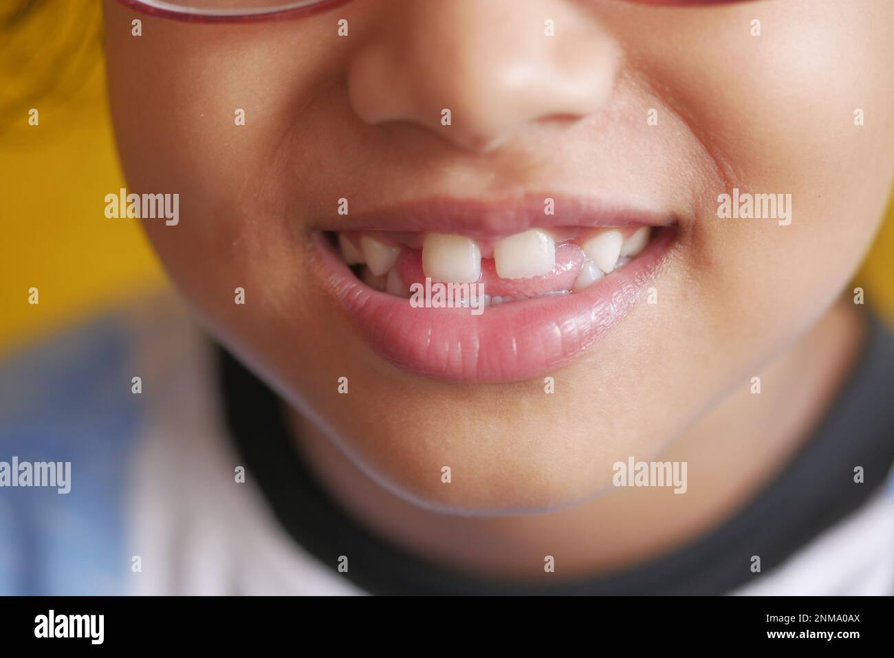 Kind Mädchen mit deformierten Zähnen Stockfoto
