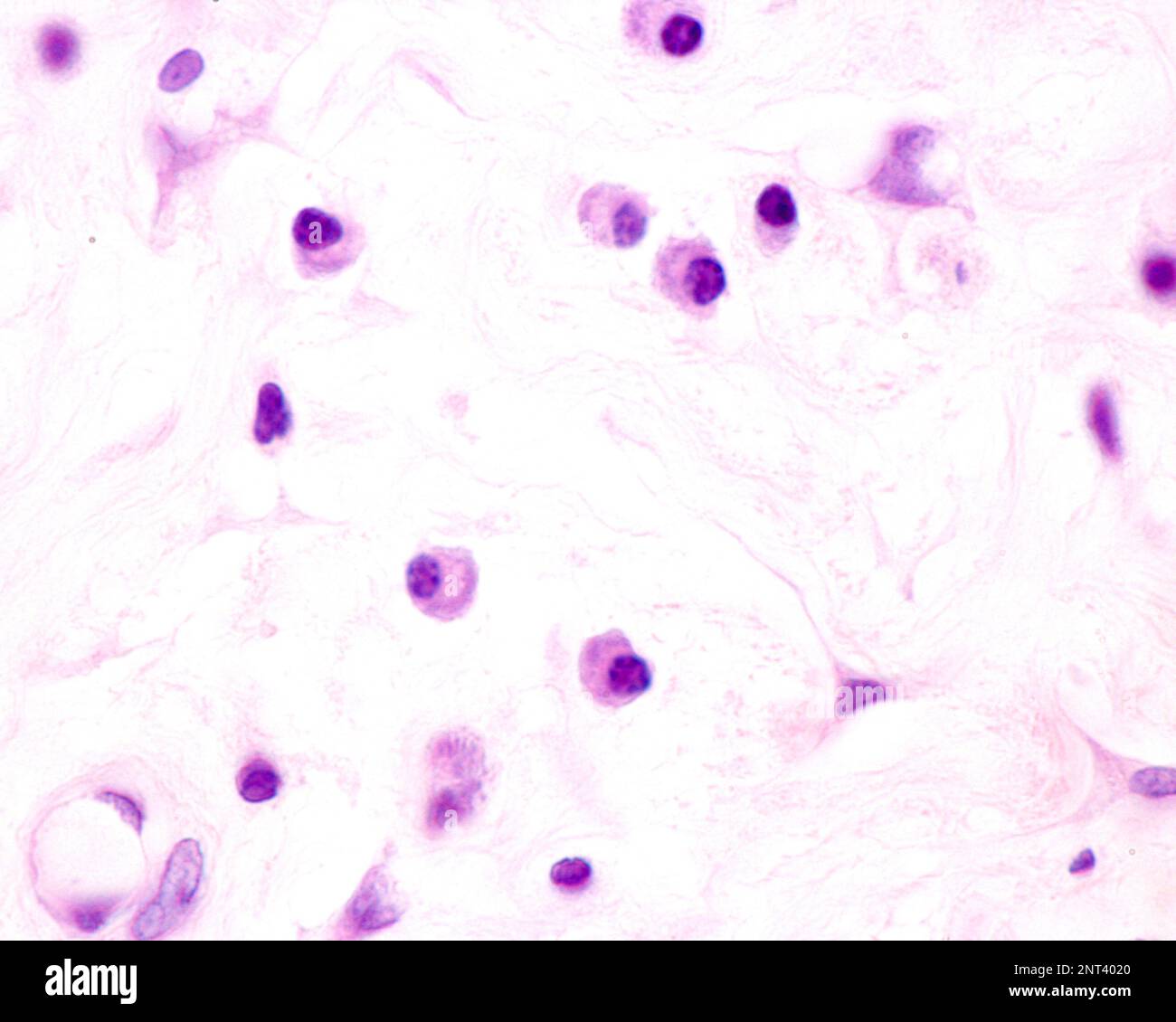 Plasmazellen sind B-Lymphozyten, die durch die Anwesenheit von Antigenen aktiviert werden, die große Mengen von Antikörpern absondieren. Sie treten in Geweben auf, die von c betroffen sind Stockfoto
