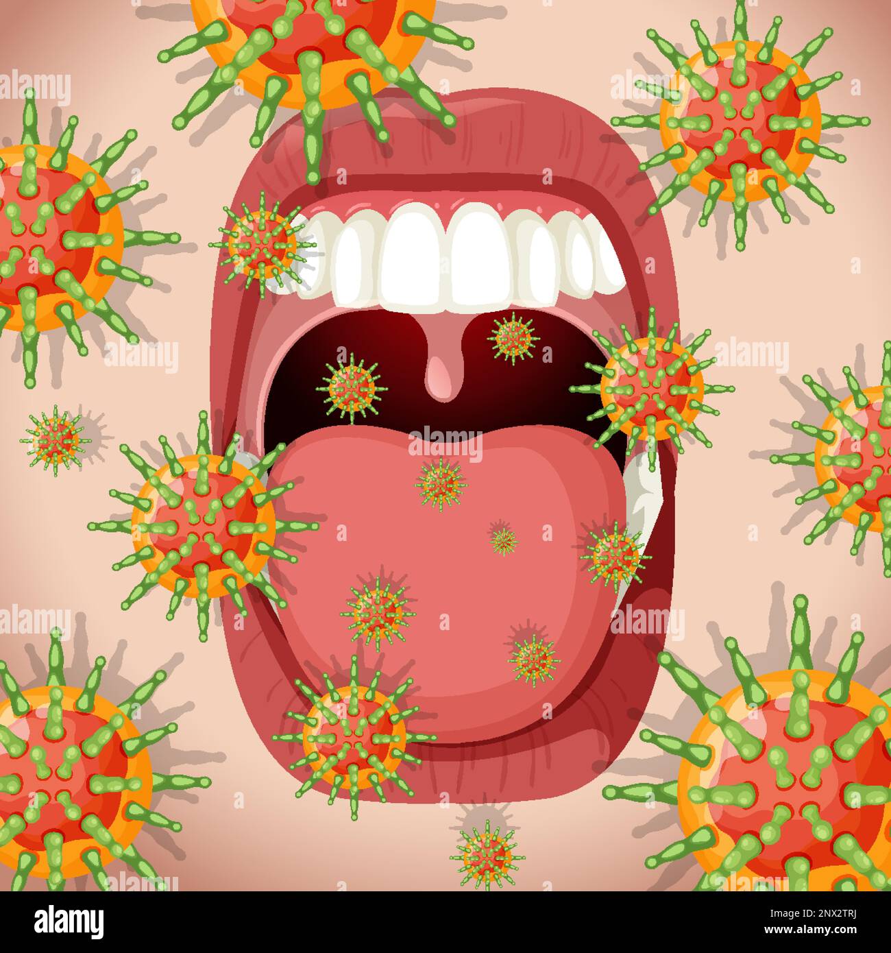 Herpes-simplex-Virus (Lippen/Mund) Illustration Stock Vektor