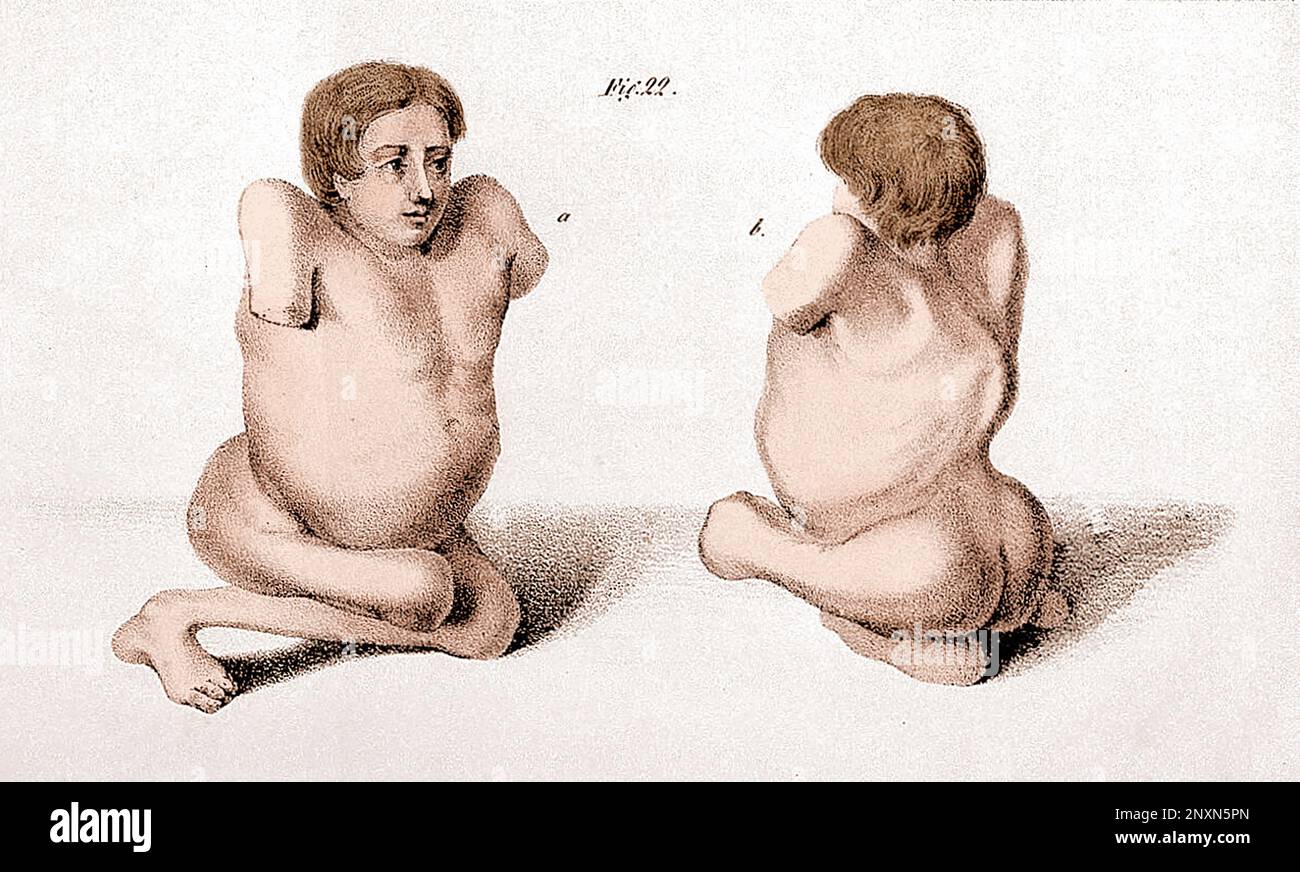 Darstellung von Deformation und Lähmung durch Polio. Aus "Beobachtungen über Lähmungszustände der unteren Extremitäten und ihre Behandlung" von Jacob von Heine, 1840. Die erste klinische Beschreibung von Polio wurde 1789 vom englischen Arzt Michael Underwood gegeben, wo er Polio als „eine Schwäche der unteren Extremitäten“ bezeichnet. Die Arbeit der Ärzte Jacob Heine im Jahr 1840 und Karl Oskar Medin im Jahr 1890 führte dazu, dass sie als Heine-Medin-Krankheit bekannt wurde. Die Krankheit wurde später als infantile Lähmung bezeichnet, basierend auf ihrer Neigung, Kinder zu befallen. Gefärbt. Stockfoto