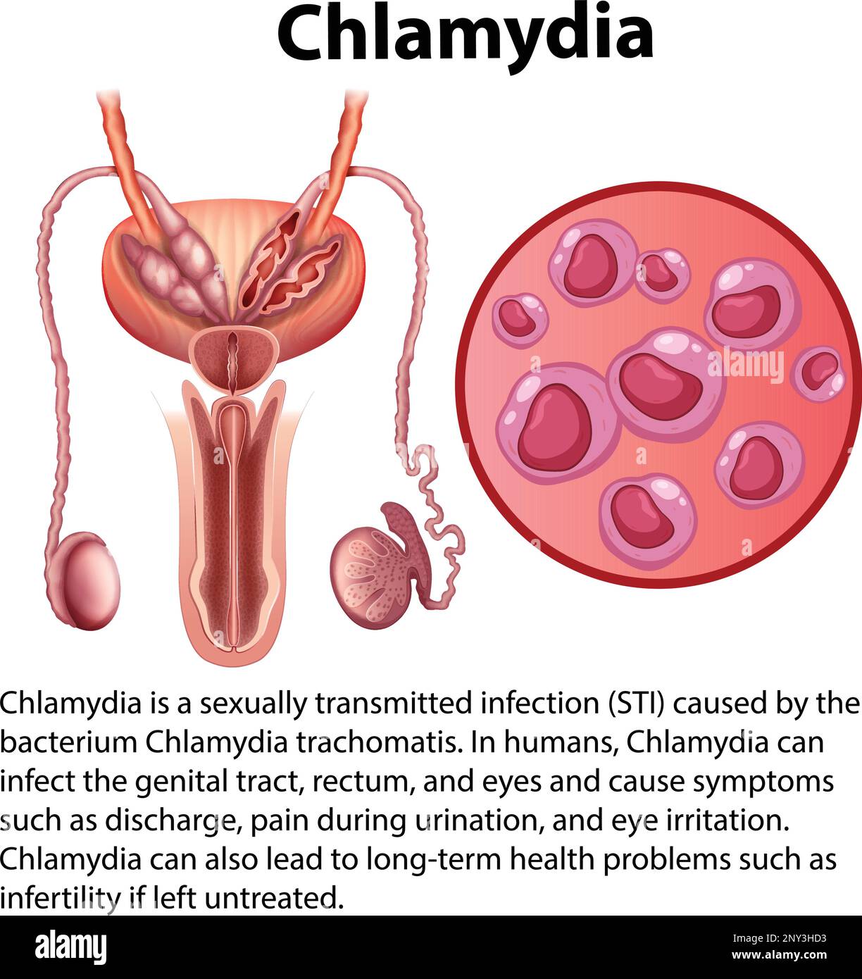 Chlamydia trachomatis mit erläuternder Darstellung Stock Vektor