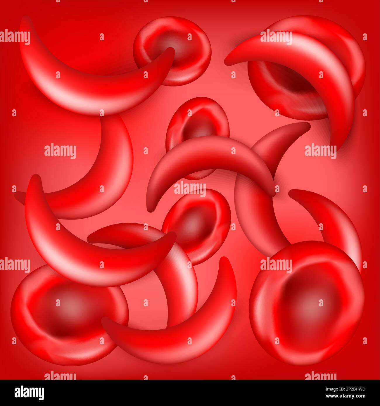 Sichelzellkrankheit. SCD. Normale Erythrozyten und Sichelzellen im Blutfluss. Roter Hintergrund. Anämie oder Anämie. Erkrankungen des Blutes. Vektorposter Stock Vektor