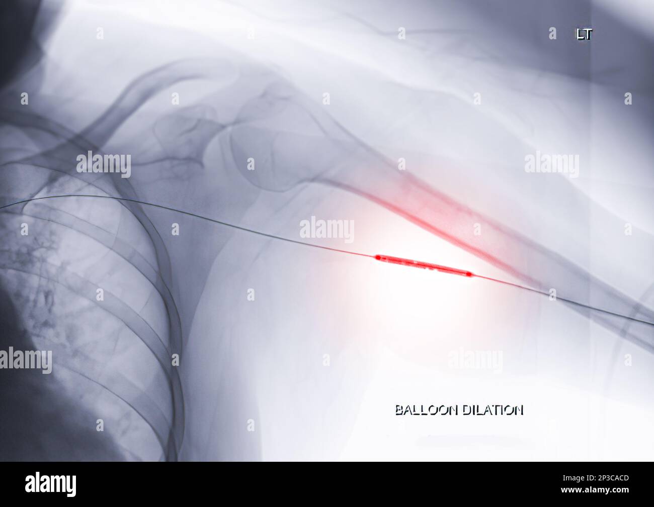 Angioplastie, Ballonangioplastie und perkutane transluminale Angioplastie (PTA) am linken Arm. Stockfoto