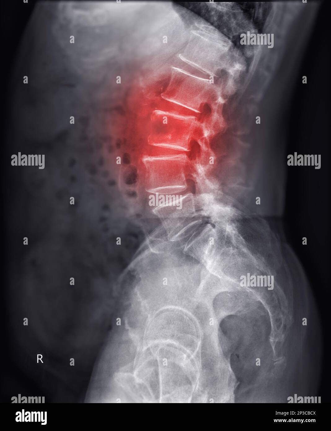 Röntgenbild der Lambosakralwirbelsäule oder L-S-Wirbelsäule mit Läsion bei L3. Stockfoto