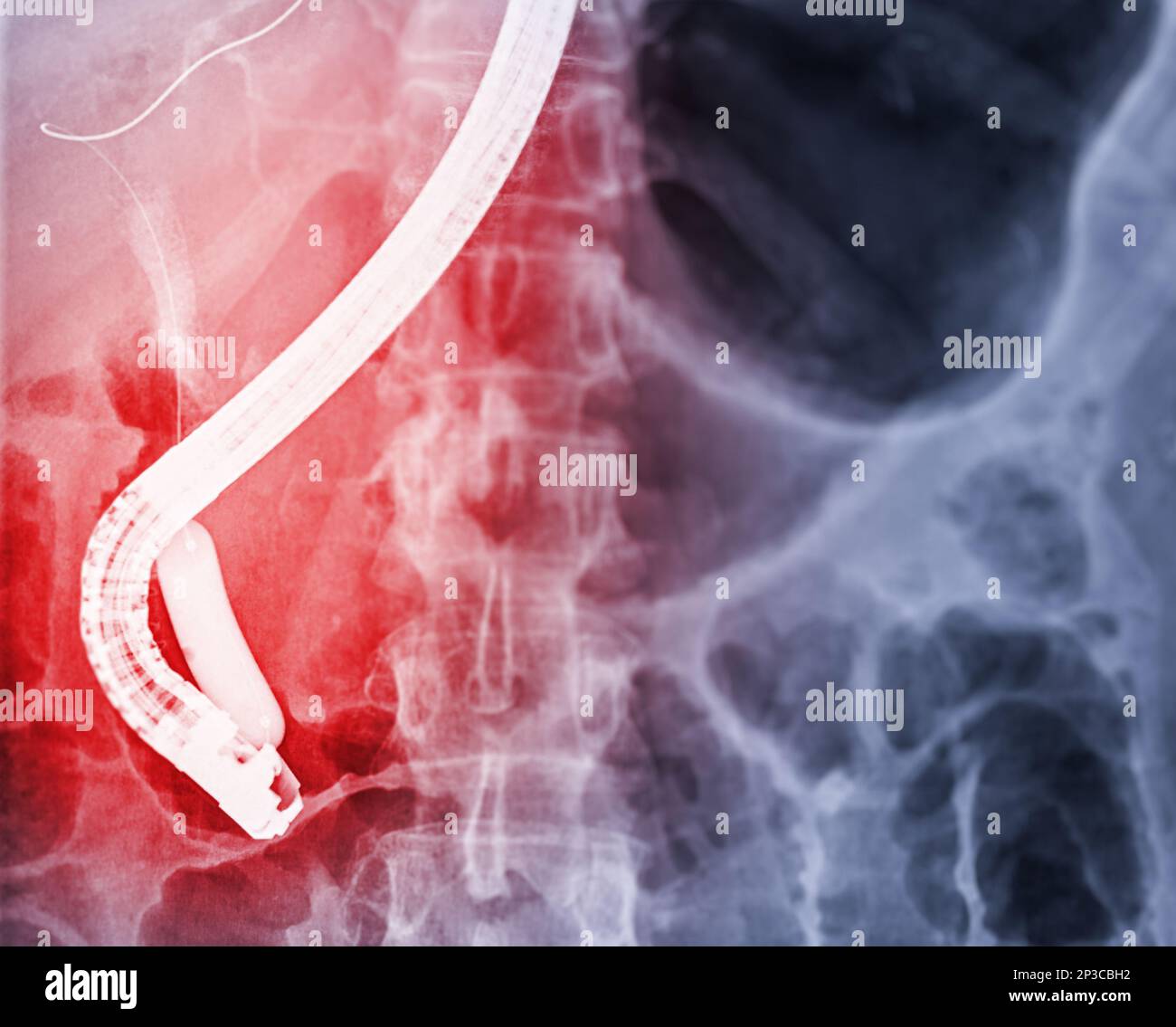 Röntgenbild endoskopischer ERCPArzte und laparoskopischer