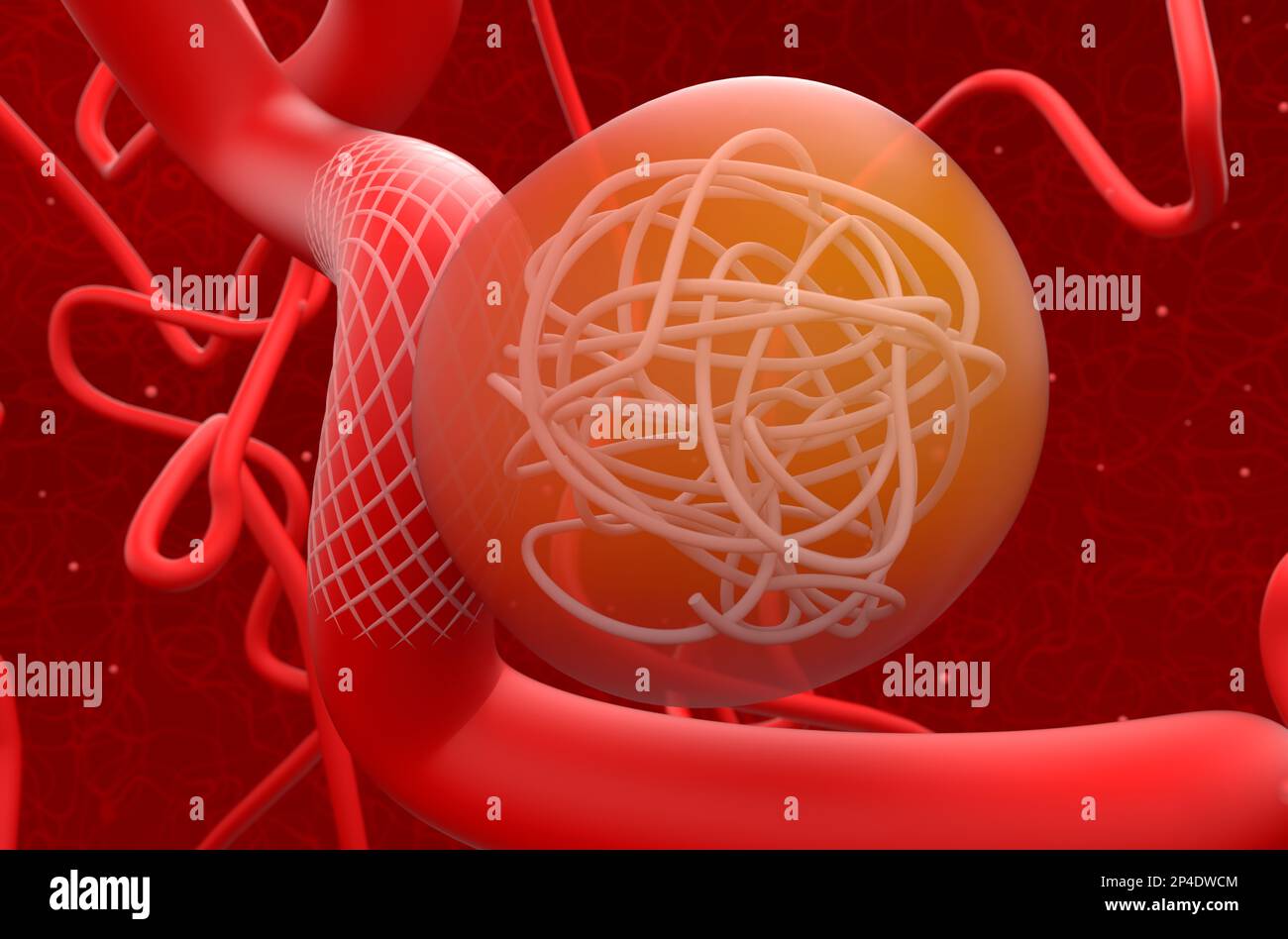 Aneurysmabehandlung mit Netzstent und Spulen – 3D-Darstellung der Nahaufnahme Stockfoto