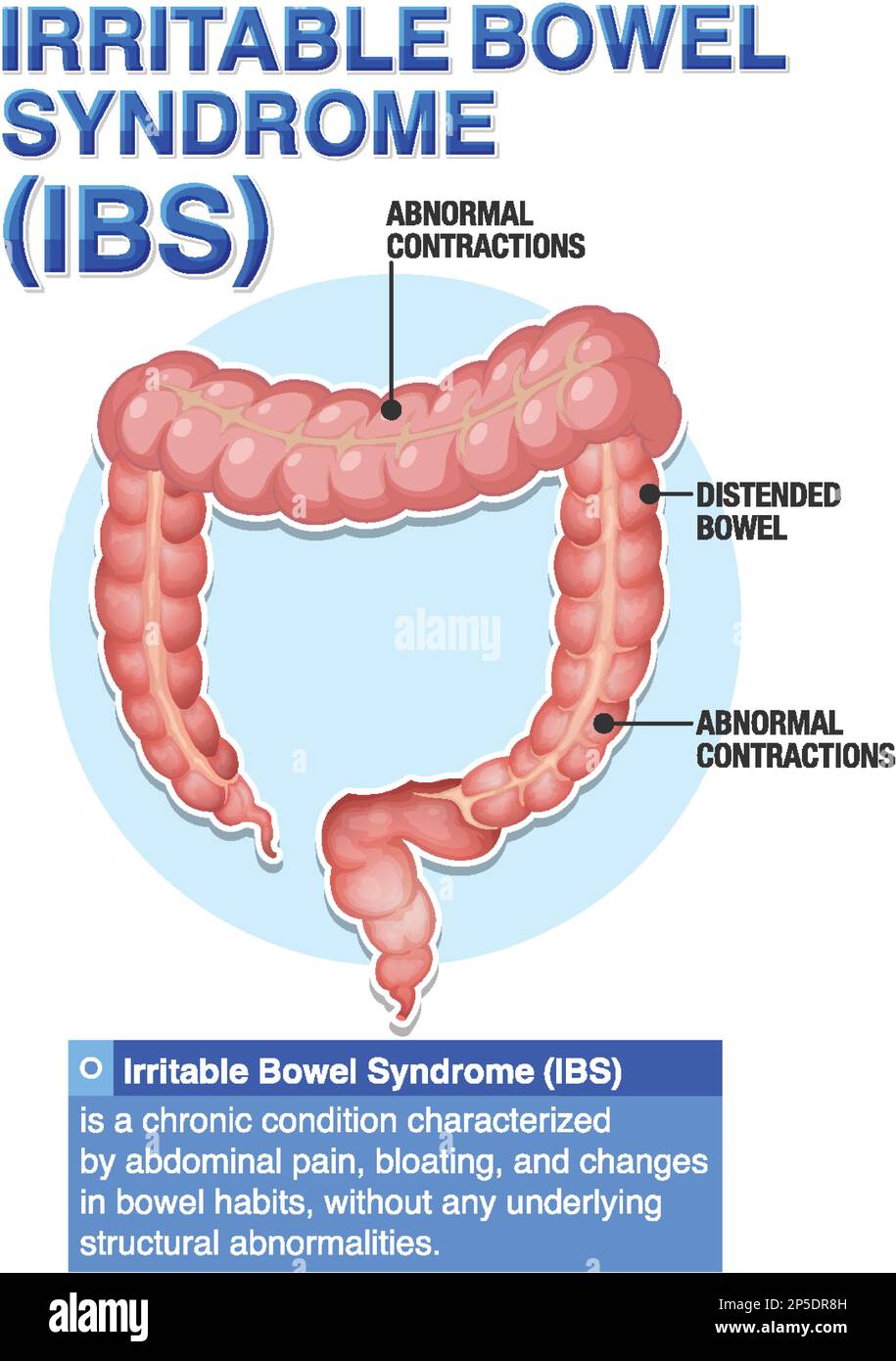 Irritable-Darm-Syndrom (IBS) Infografik Illustration Stock Vektor