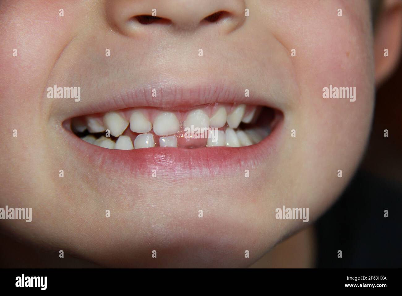 Baby-Zahn-Verlust Stockfoto