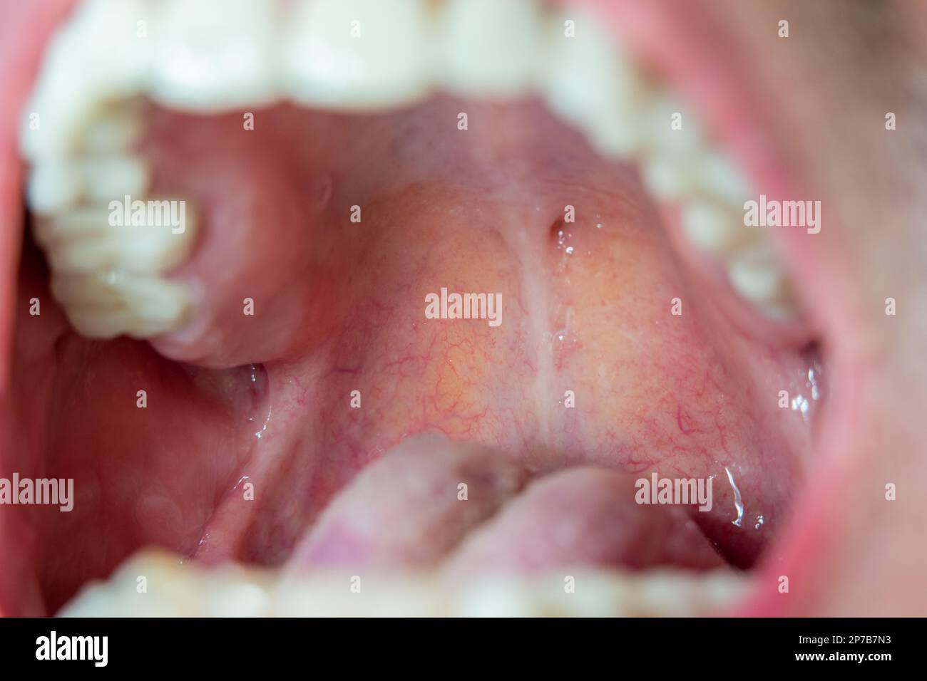 Halsrückseite, Munddach Makroansicht des weißen männlichen Rachens. Stockfoto