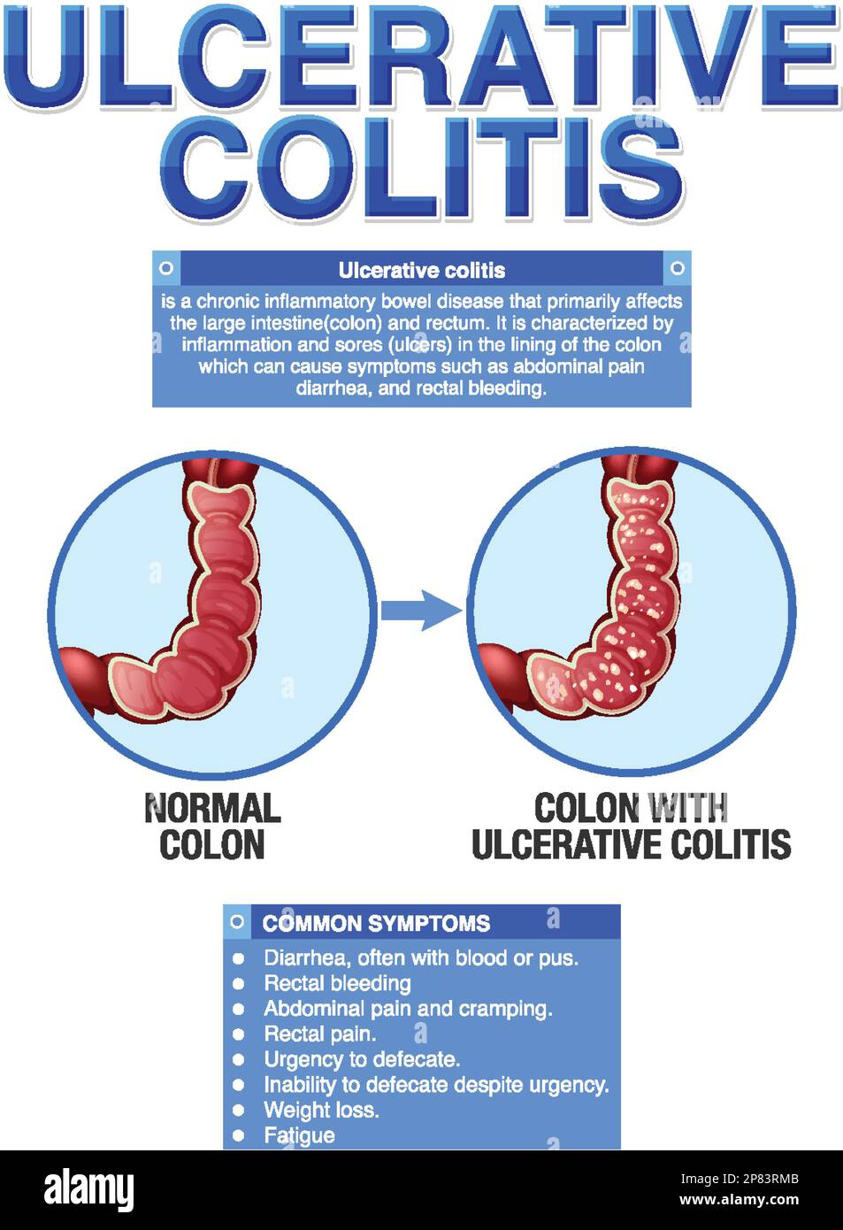 Colitis ulcerosa Symptome Infographische Illustration Stock Vektor