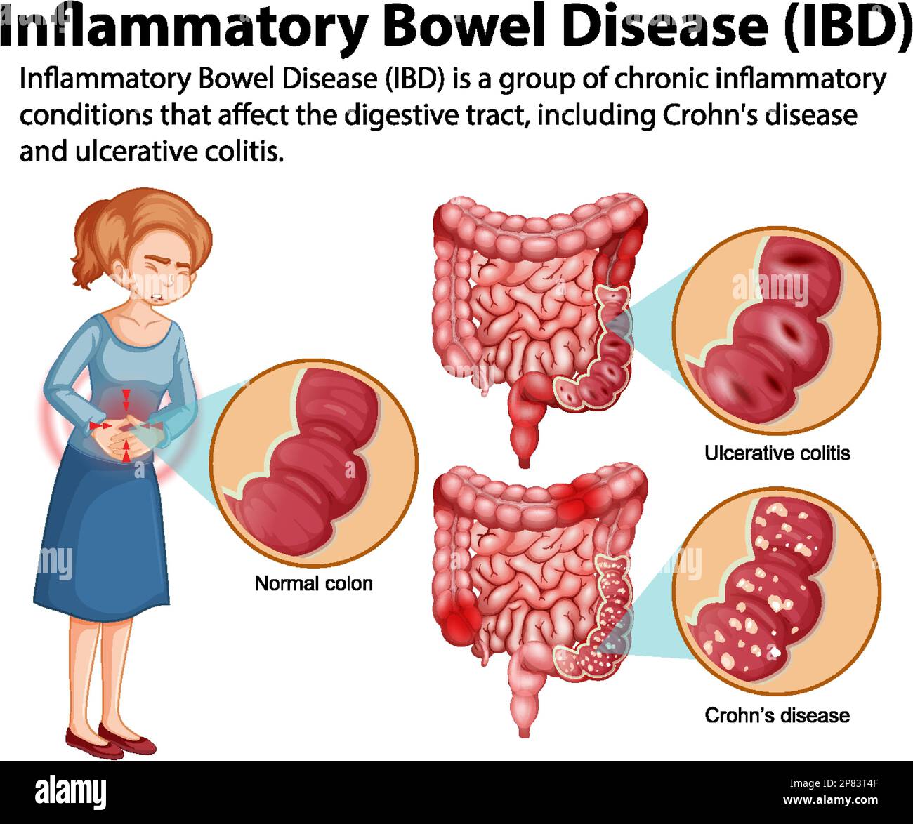 Chronisch entzündliche Darmerkrankungen (IBD) Infografik Illustration Stock Vektor