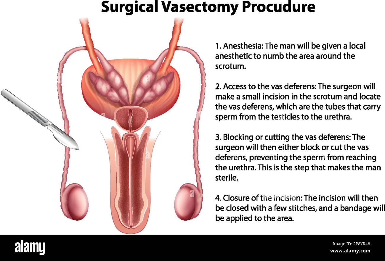 Infografik zur chirurgischen Vasektomie mit erläuternder Darstellung Stock Vektor