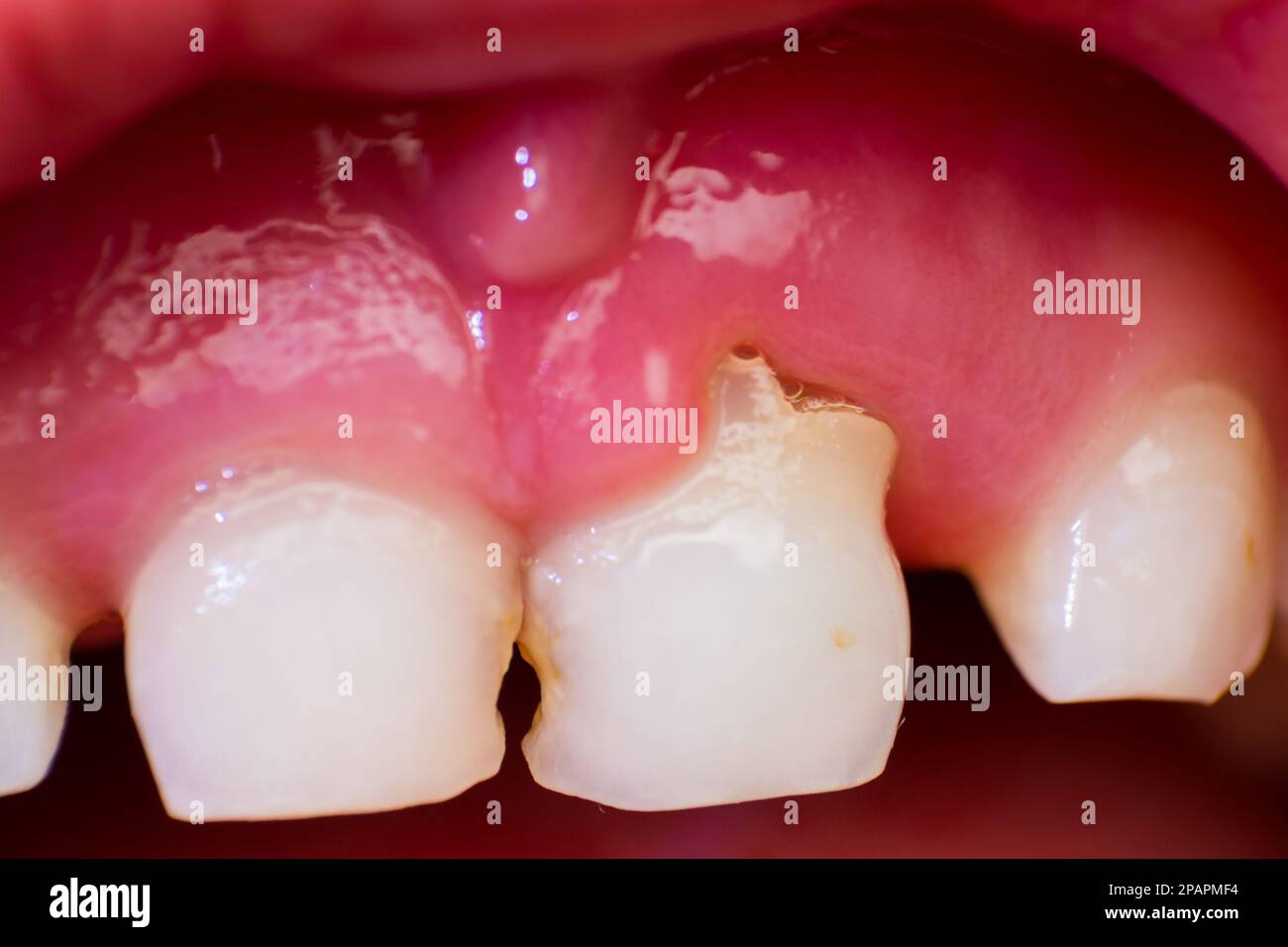Nahaufnahme eines Schneidezahns, der kurz vor dem Ausbruch eines 7-jährigen Kindes steht Stockfoto