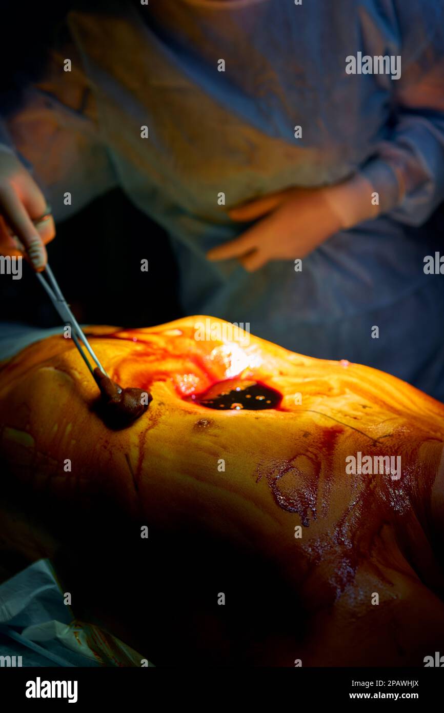 Chirurgenhände mit Instrumenten bei Betadin Stockfoto