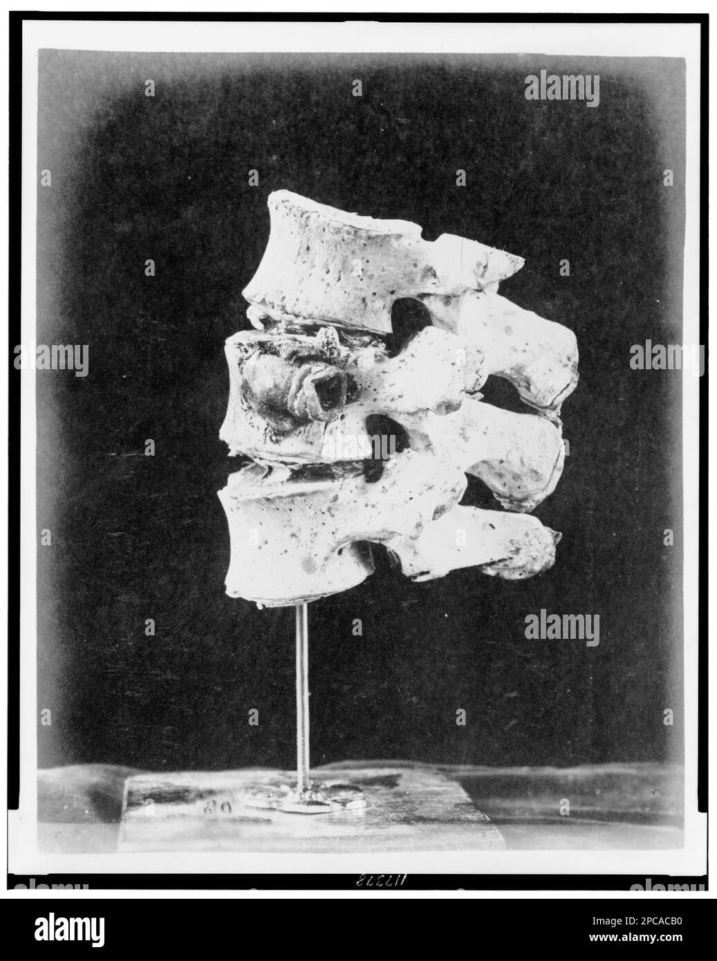 Untere Hälfte des rechten Femurs, Kugel über dem inneren Kondylus. Illus. In: Fotografien von chirurgischen Fällen und Proben / erstellt von [..] George A. Otis, Assistenzchirurg, USA Washington - Das Büro des Chirurgen, nein 19, fotografiert im Army Medical Museum. Bones, 1860-1870, Kriegsopfer, Tennessee, Jackson, 1860-1870, Usa, Geschichte, Bürgerkrieg, 1861-1865, Medizinische Aspekte. Stockfoto