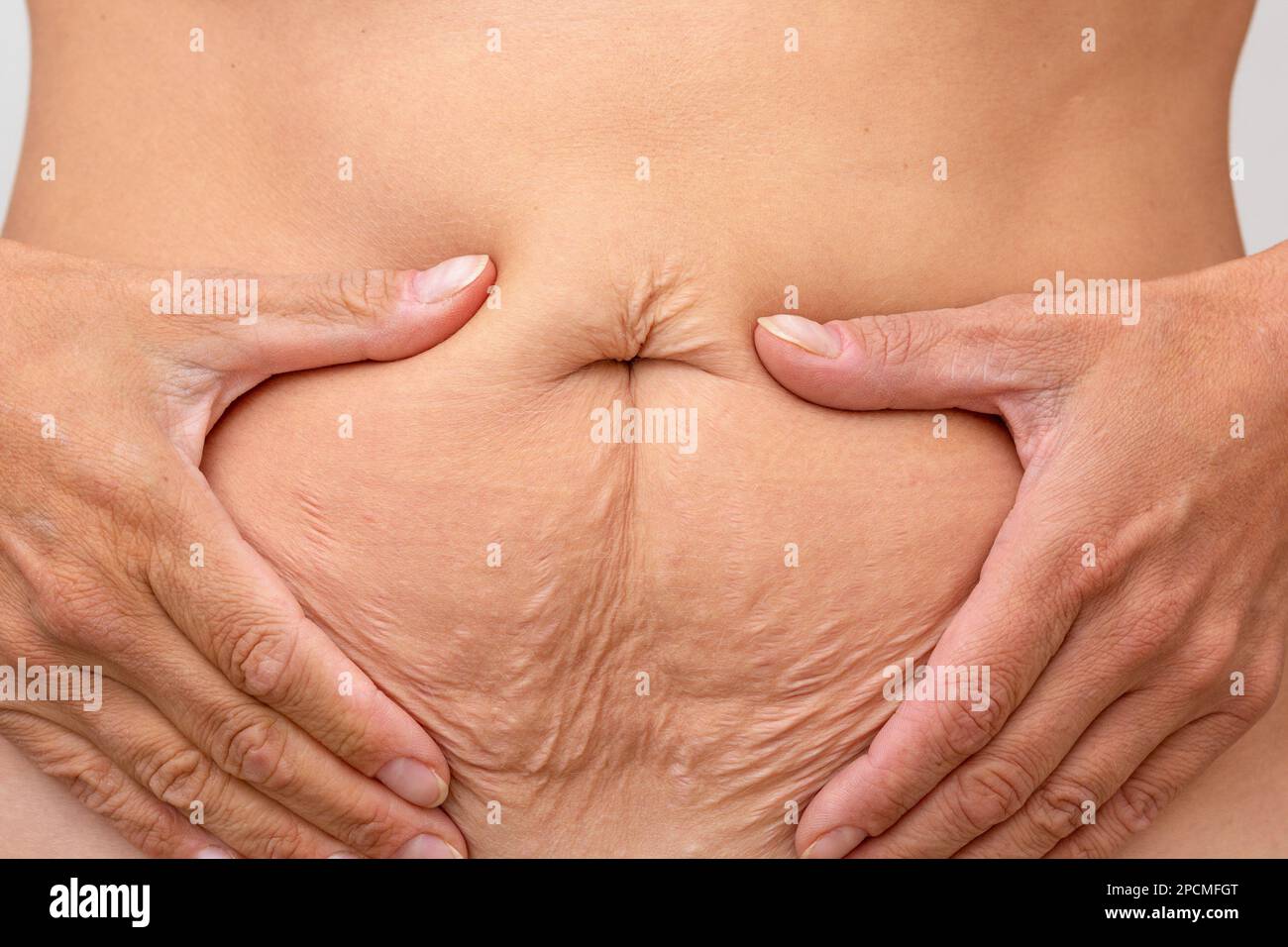 Gekürzte Frau Hände auf dem Bauch gepresste Haut, um schlaffe Haut nach der Diät und Dehnungsstreifen nach der Schwangerschaft zu zeigen Stockfoto