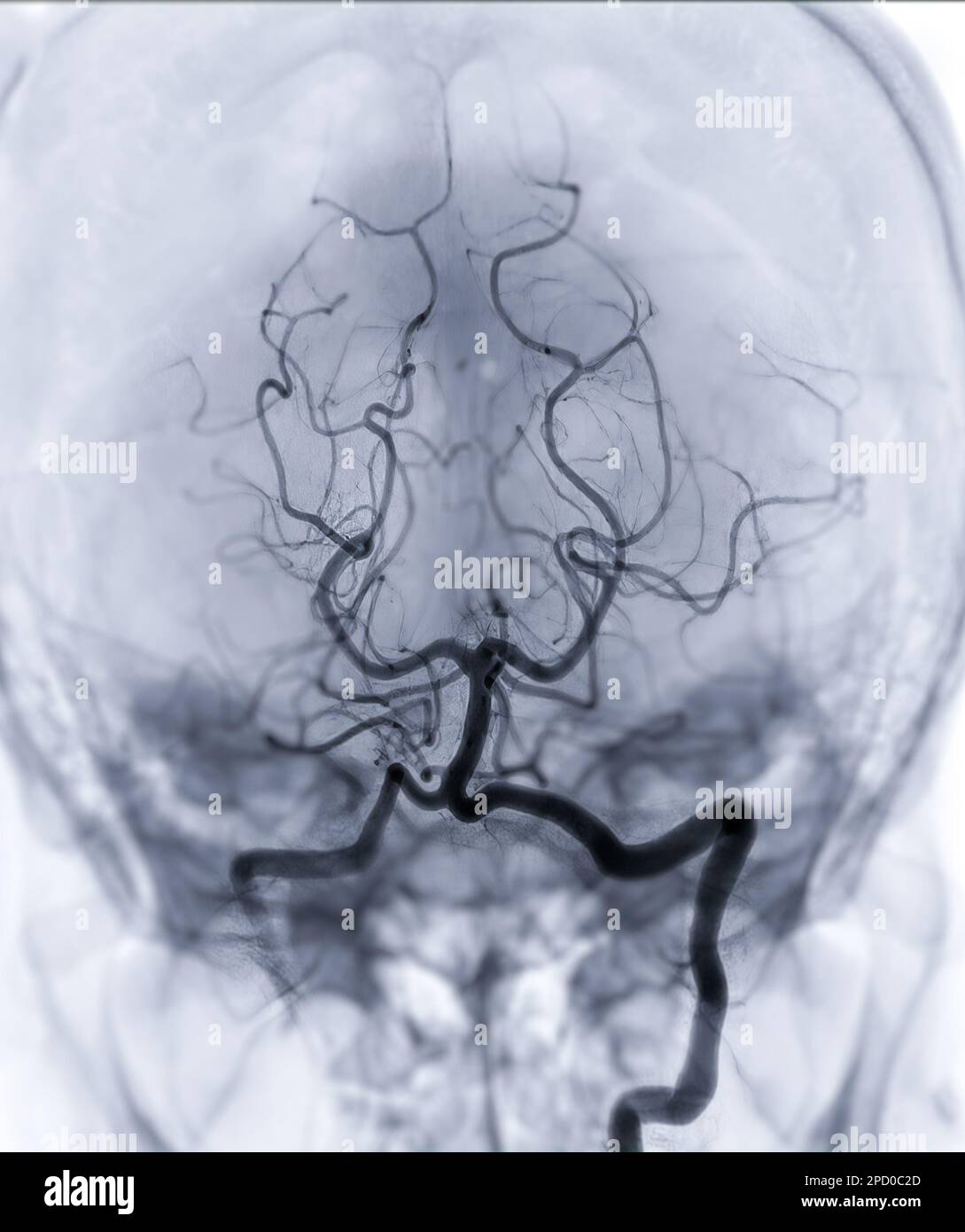 Zerebrale Angiographie Imageor potesteriore Arteria cerebri aus der Fluoroskopie in der Interventionsradiologie mit Darstellung der Arteria basilaris. Stockfoto