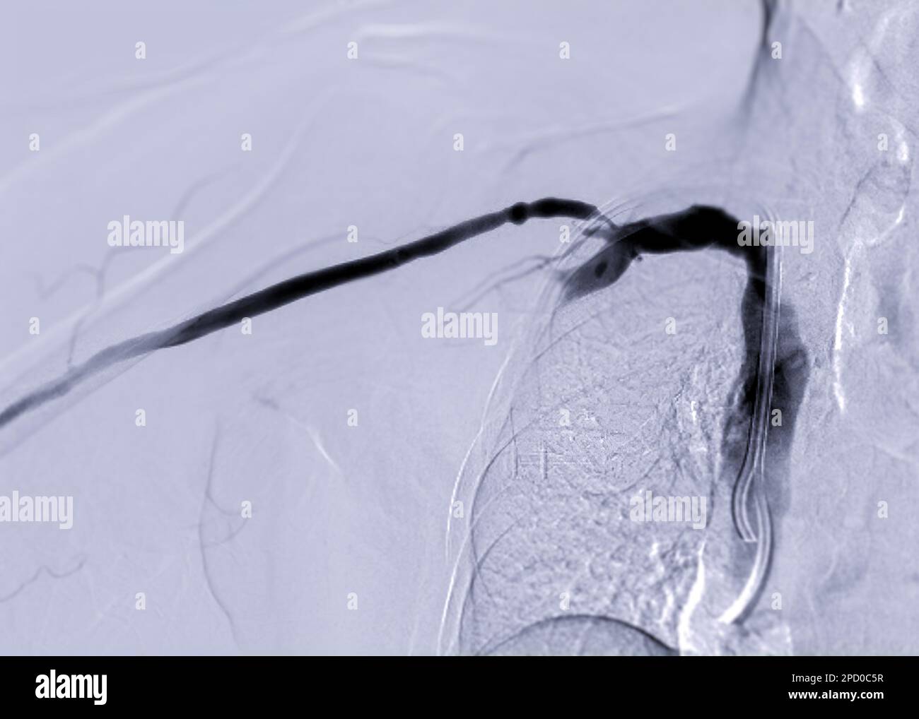 Bild der Angioplastie, Ballonangioplastie und perkutanen transluminalen Angioplastie (PTA). Stockfoto