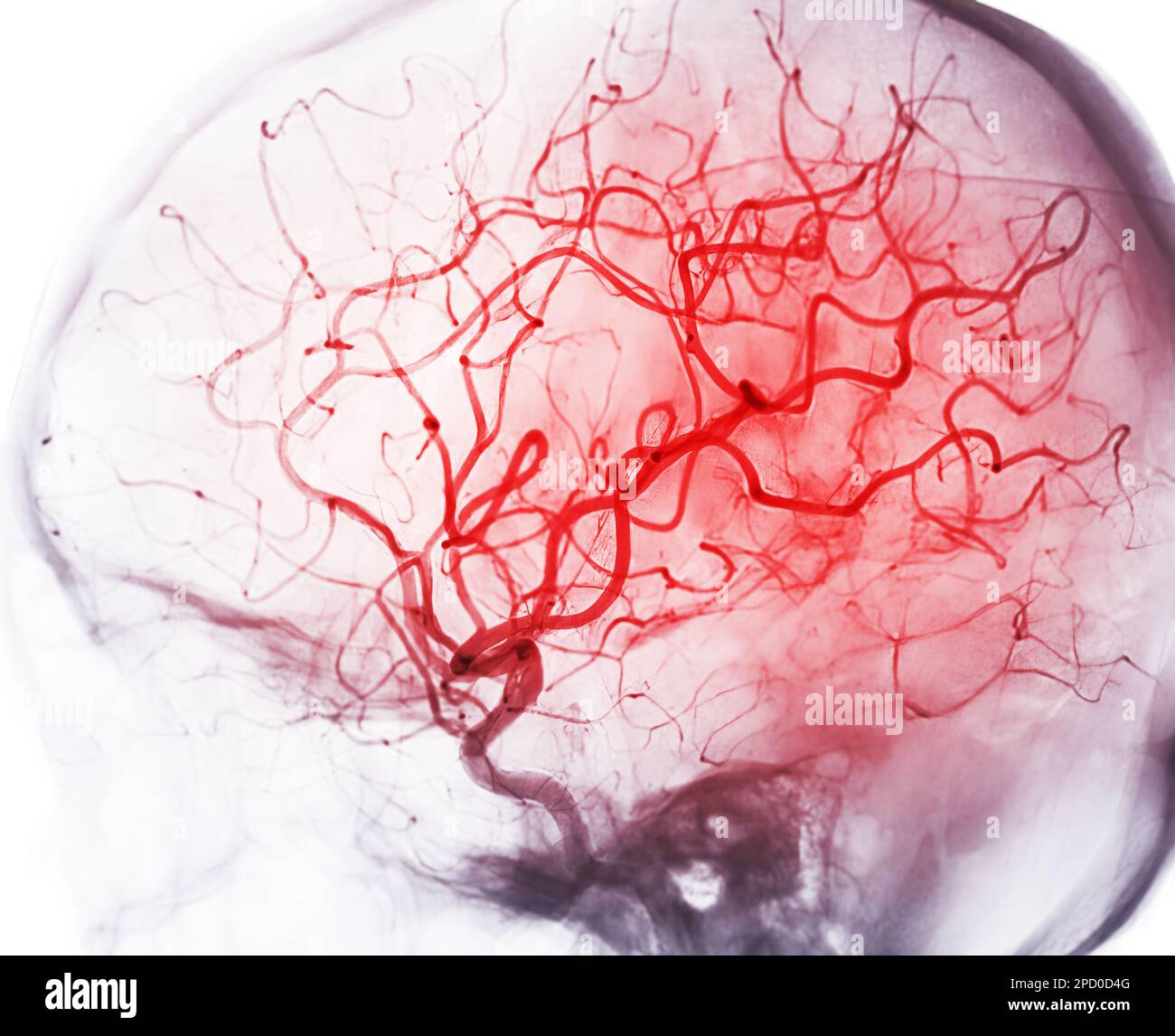 Zerebrale Angiographie aus der Fluoroskopie in der Interventionsradiologie, die die Hirnarterie zeigt. Stockfoto